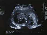 Пренатальная диагностика: Как часто можно проходить УЗИ во время беременности?